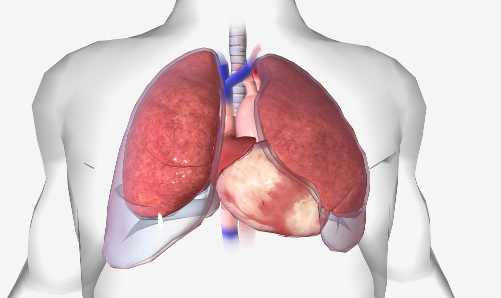 Pleural effusion