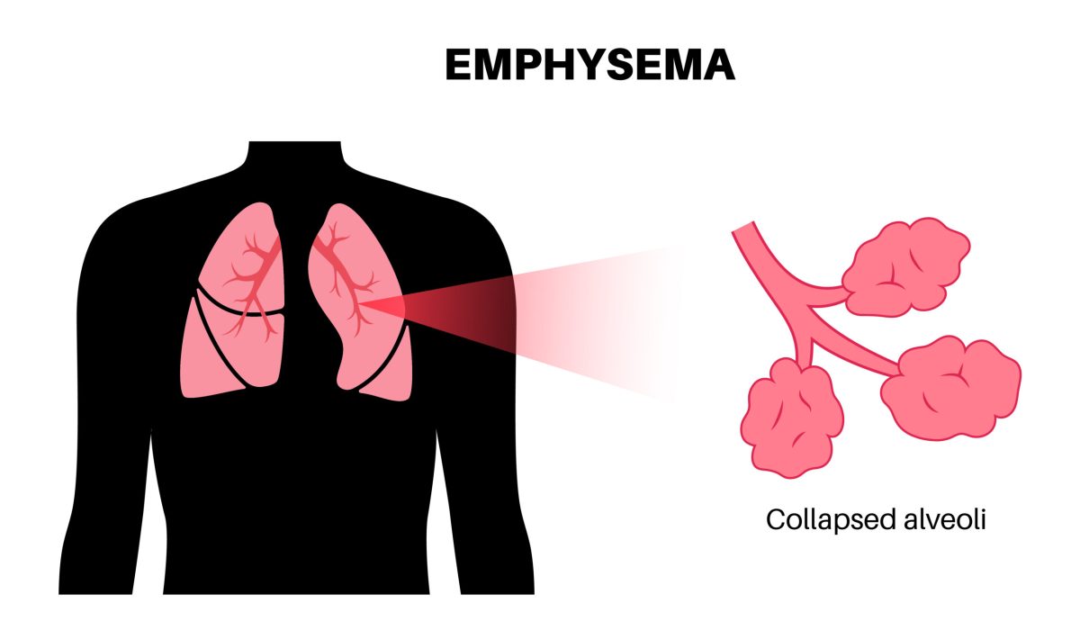 Emphysema disease concept. Damaged alveoli, failure airway. Floppy walls between air sacs in human lungs. Shortness of breath, chest tightness. Illness of respiratory system flat vector illustration